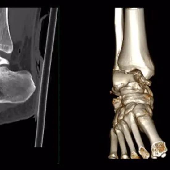 3d ct ankle